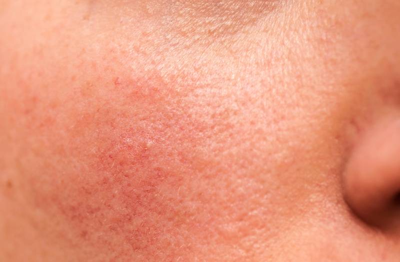 Comment prévenir l'apparition de petits boutons blancs sur le corps ?